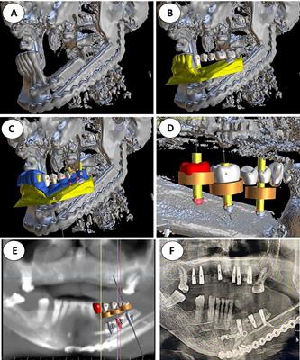 Computer-Assisted Dental Implant Placement Following Free Flap Reconstruction: Virtual Planning, CAD/CAM Templates, Dynamic Navigation and Augmented Reality